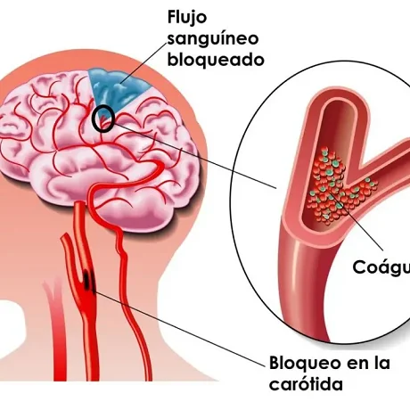 Evita los derrames cerebrales
