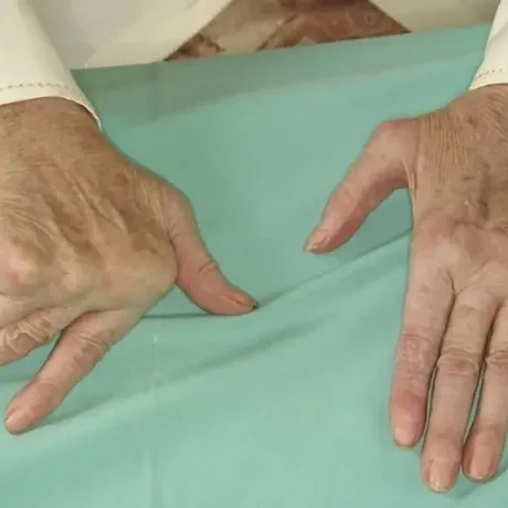 Alivia la artritis reumatoide