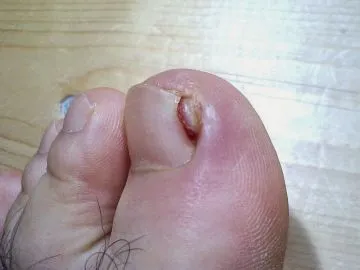 Cómo curar los hongos en las uñas de los pies