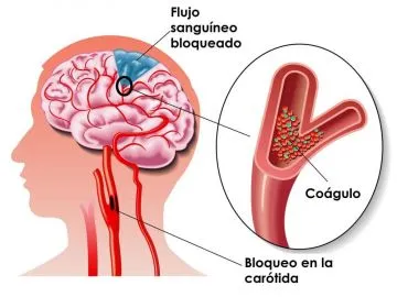 Evita los derrames cerebrales