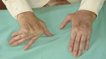 Alivia la artritis reumatoide