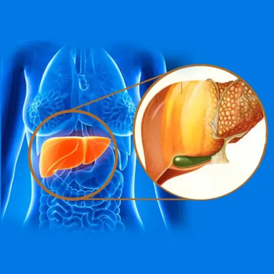 El Hígado graso provoca exceso de toxinas en tu cuerpo y engorde repentino.